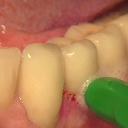 Interdental brushing prior to the application of Perisolv