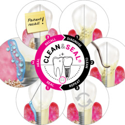 Protocollo Clean and Seal con Perisolv e hyaDENT BG