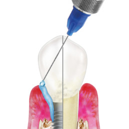 Applicazione di hyadent BG in caso di parodontite e rendering di perimplantite