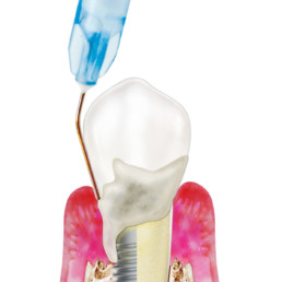 Application of Perisolv in case of periodontitis and peri-implantitis rendering