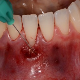 Clinical case by Prof Anton Sculean: Application of cross-linked hyaluronic acid gel, hyadent BG, into tunnel
