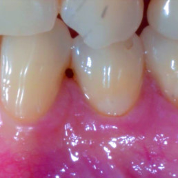 Post-of gingival recession with hyadent BG 6 months