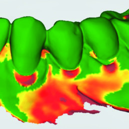 Soft tissue augmentation scan3D