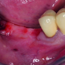 Zahnärztlicher klinischer Fall von Darko Bo,zic: Behandlung von schwerem Knochenschwund mit vernetztem Hyaluronsäure-Gel, hyadent BG, einem REGEDENT-Produkt