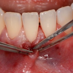 Mobilised tunnel for a gingival recession by Prof Anton Sculean