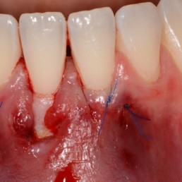 Caso clinico di Anton Sculean CTG in chirurgia dentale a tunnel con hyadent BG, un gel di acido ialuronico reticolato, un prodotto REGEDENT