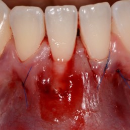 Dental case: Application of hyadent BG in tunnel by Prof Anton Sculean