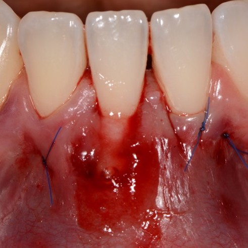 Caso dentale: Applicazione di hyadent BG nel tunnel del Prof. Anton Sculean