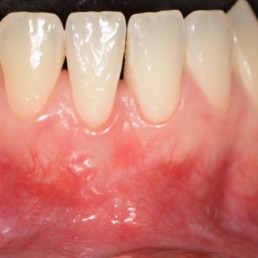 Cas dentaire par le Prof Anton Sculean, 1 an post-op après une chirurgie du tunnel avec du gel d'acide hyaluronique réticulé, hyadent BG