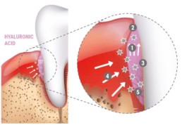 Infographie : Mode d'action du gel d'acide hyaluronique réticulé, hyaDENT BG, dans les poches parodontales et la chirurgie dentaire