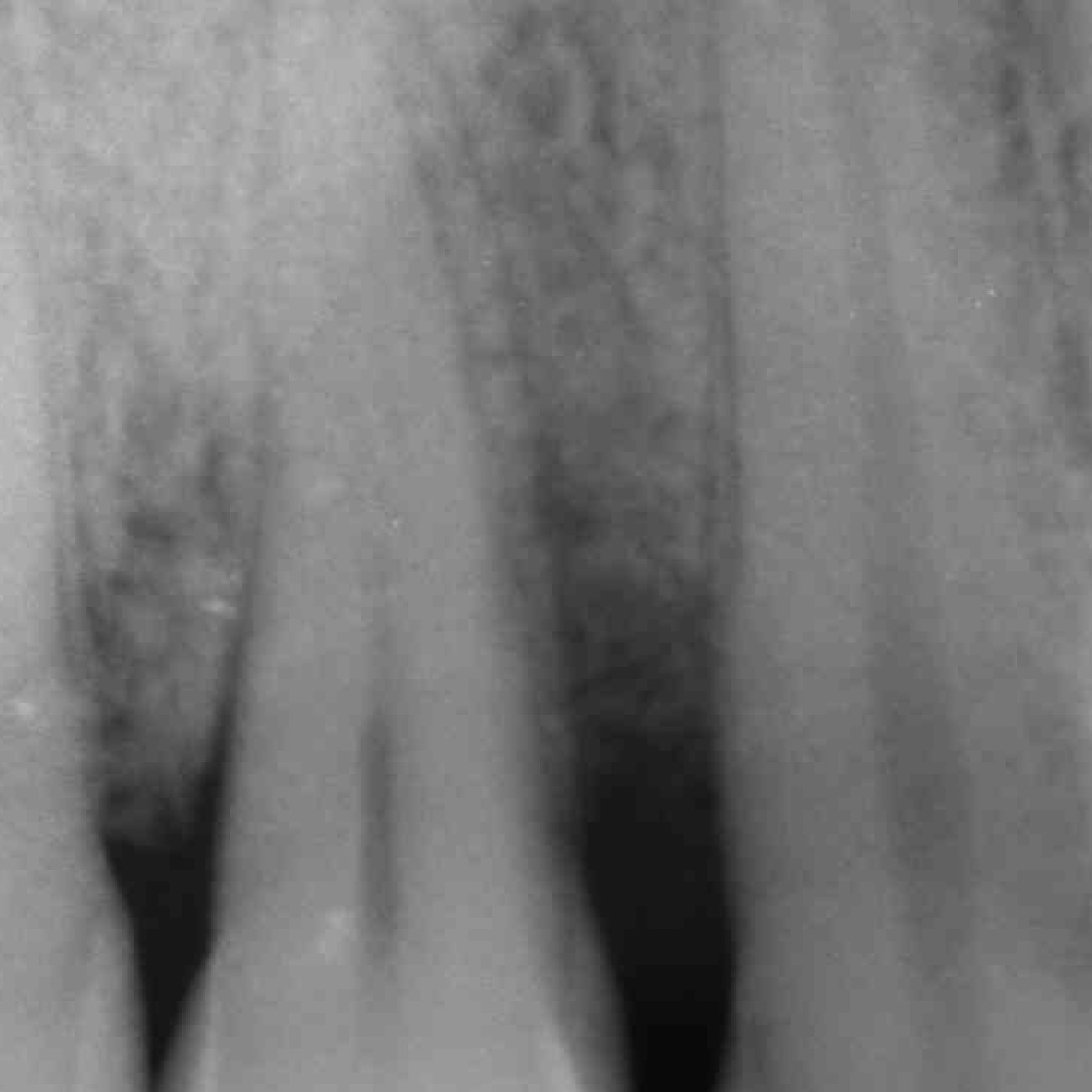 Zahnärztlicher Fall von Prof. Andrea PIlloni, der die Radiologie eines tiefen infraalveolären Defekts zeigt
