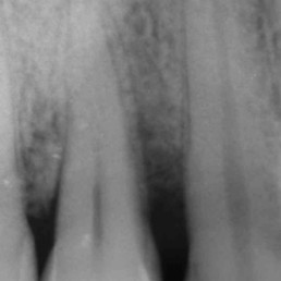 Zahnärztlicher Fall von Prof. Andrea PIlloni, der die Radiologie eines tiefen infraalveolären Defekts zeigt