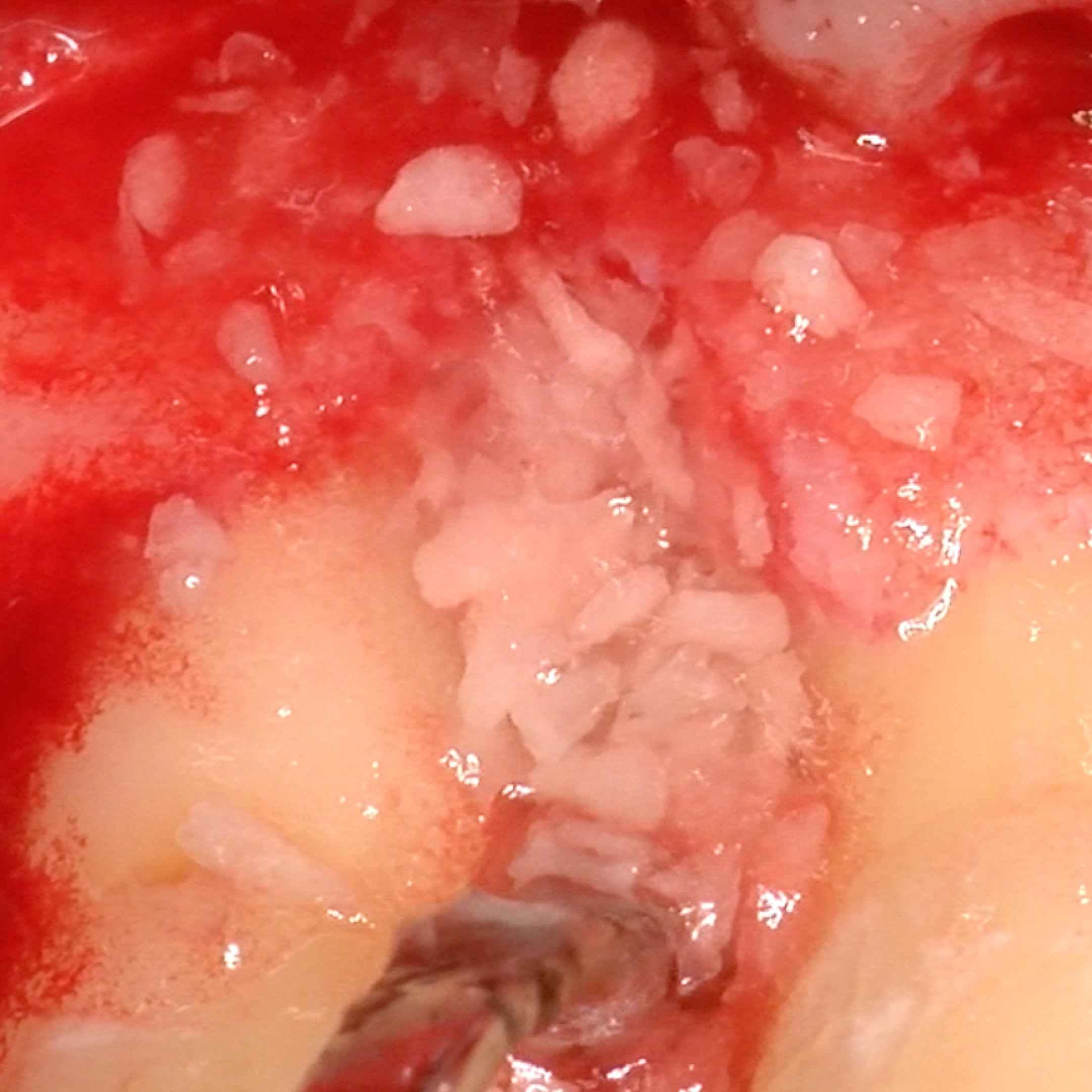 Caso odontoiatrico di rigenerazione dei tessuti duri del Prof. Pilloni che mostra il trattamento del difetto infraosseo con acido ialuronico