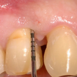 Zahnärztlicher Fall von Prof. Andrea Pilloni mit Sondierung eines infraalveolären Defekts