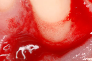 Caso odontoiatrico del Prof. Pilloni che mostra l'immagine della stabilizzazione del coagulo con il gel di acido ialuronico legato al corss hyadent BG per una più rapida rigenerazione ossea.