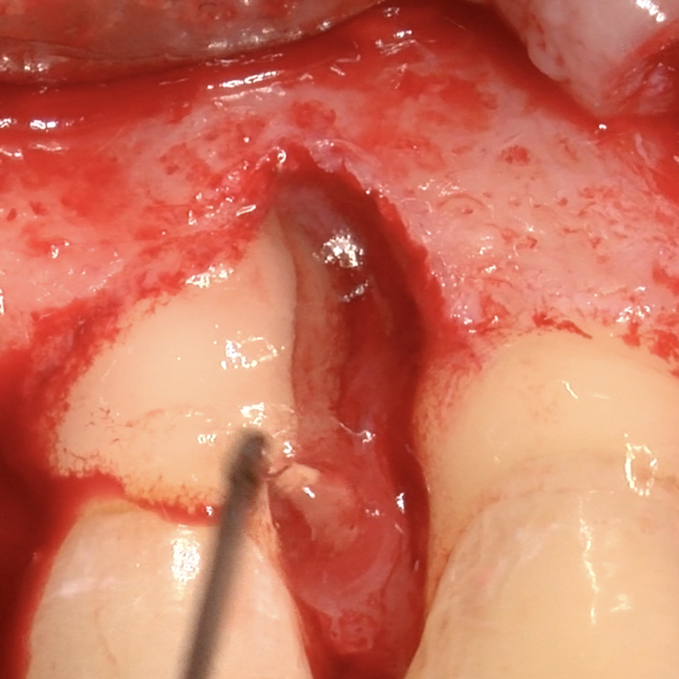 Zahnärztlicher Fall von Pilloni, der die Behandlung eines infrabones Defekts mit vernetztem Hyaluronsäure-Gel zeigt. Verwendet wurde das Produkt hyadent BG