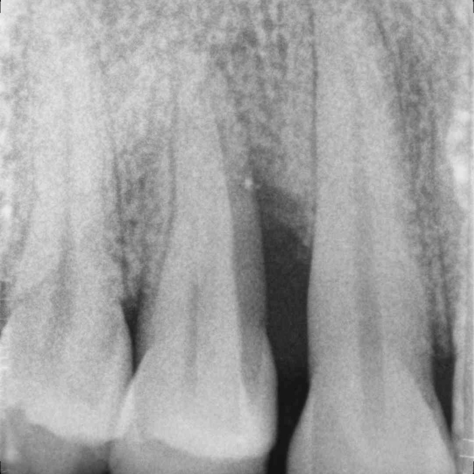 Cas dentaire par le Prof. Andrea Pilloni large défaut d'infrabonie