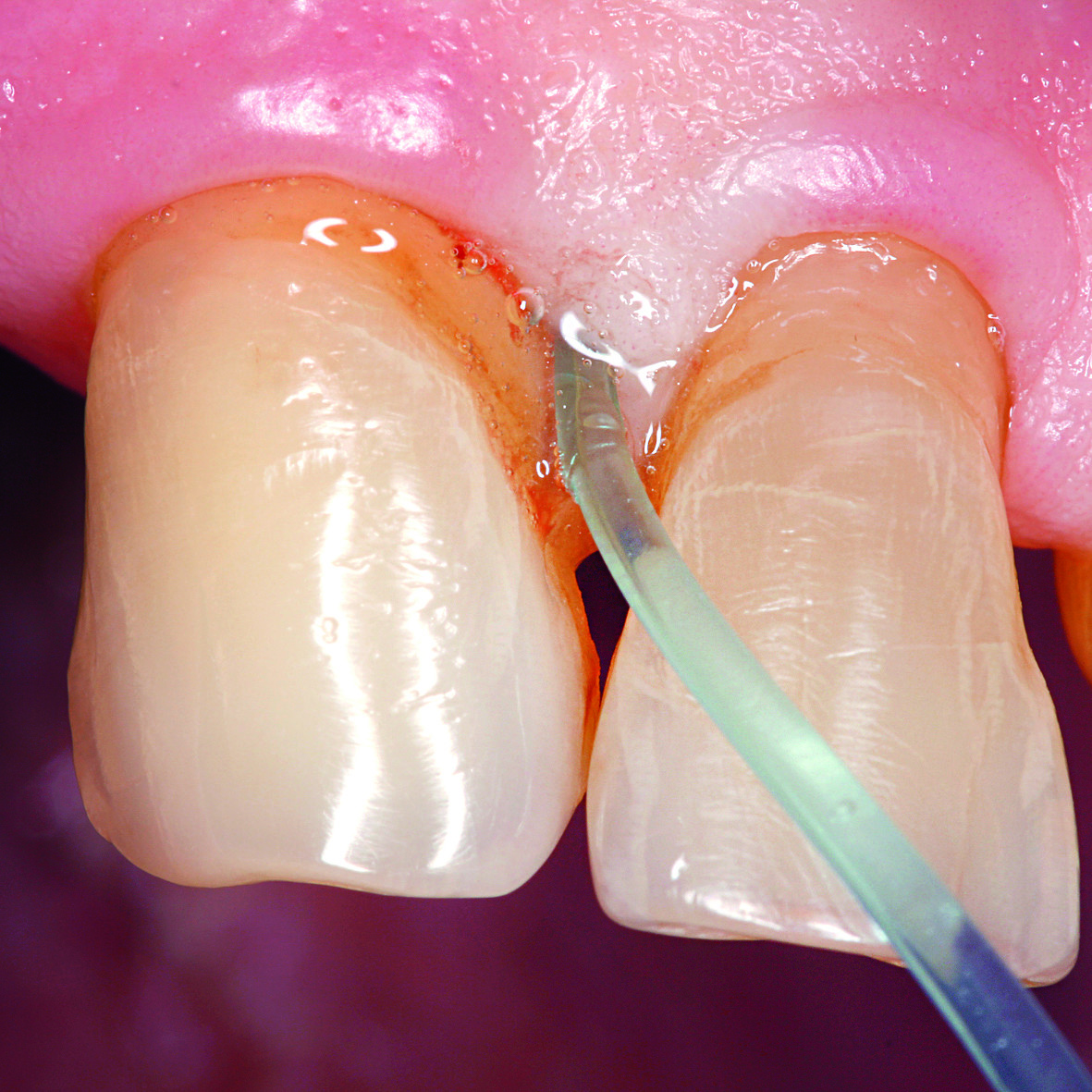 Application of Perisolv into periodontal pocket