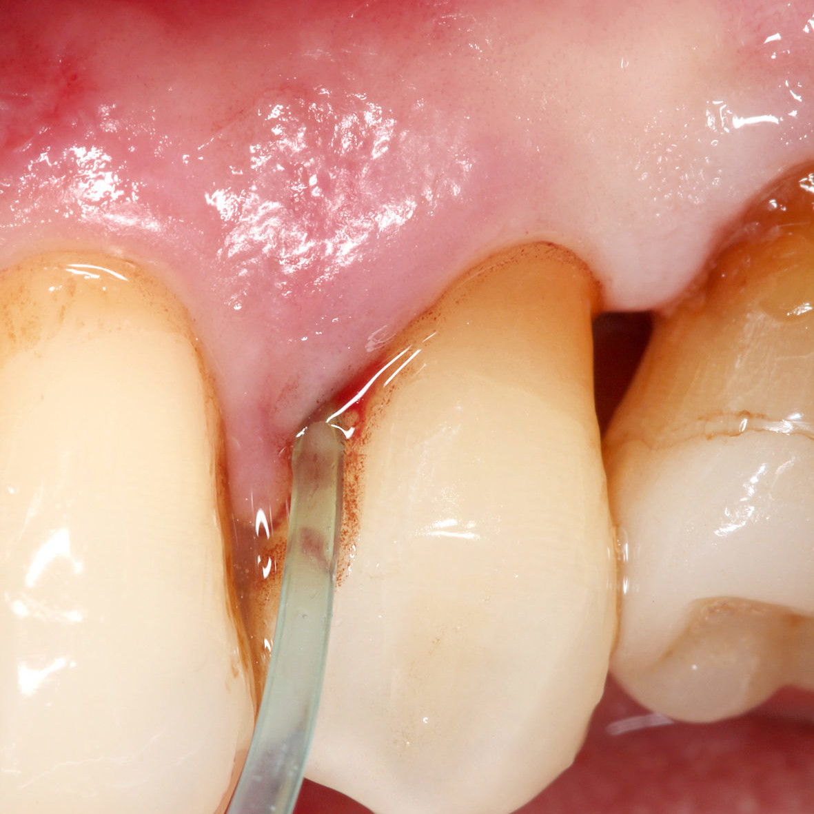 Second application of Perisolv into periodontal pocket