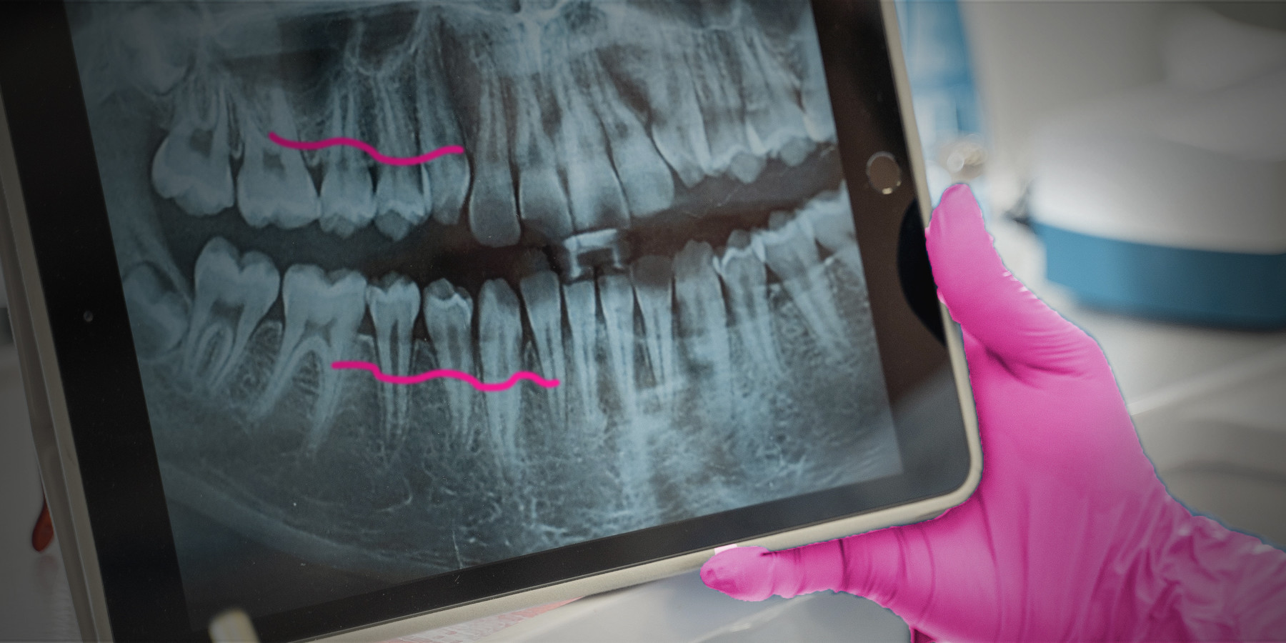 Dentiste tenant une radiographie de dents présentant un défaut intra-osseux dans le cadre d'un traitement au gel d'acide hyaluronique.