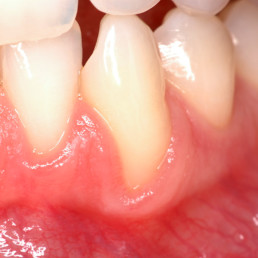 Gingival recession by Prof Andrea Pilloni