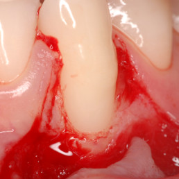 Open flap of CAF gingival recession by Andrea Pilloni