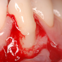 Application du gel d'acide hyaluronique réticulé, hyadent BG, dans un cas de récession dentaire par le Prof. Andrea Pilloni