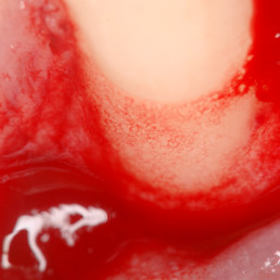 Stabilizzazione del coagulo di sangue nella recessione gengivale con hyaDENT BG, caso odontoiatrico di Andrea Pilloni