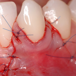 Zahnärztlicher Fall von Prof. Pilloni: Genähter Lappen bei Zahnfleischrückgang