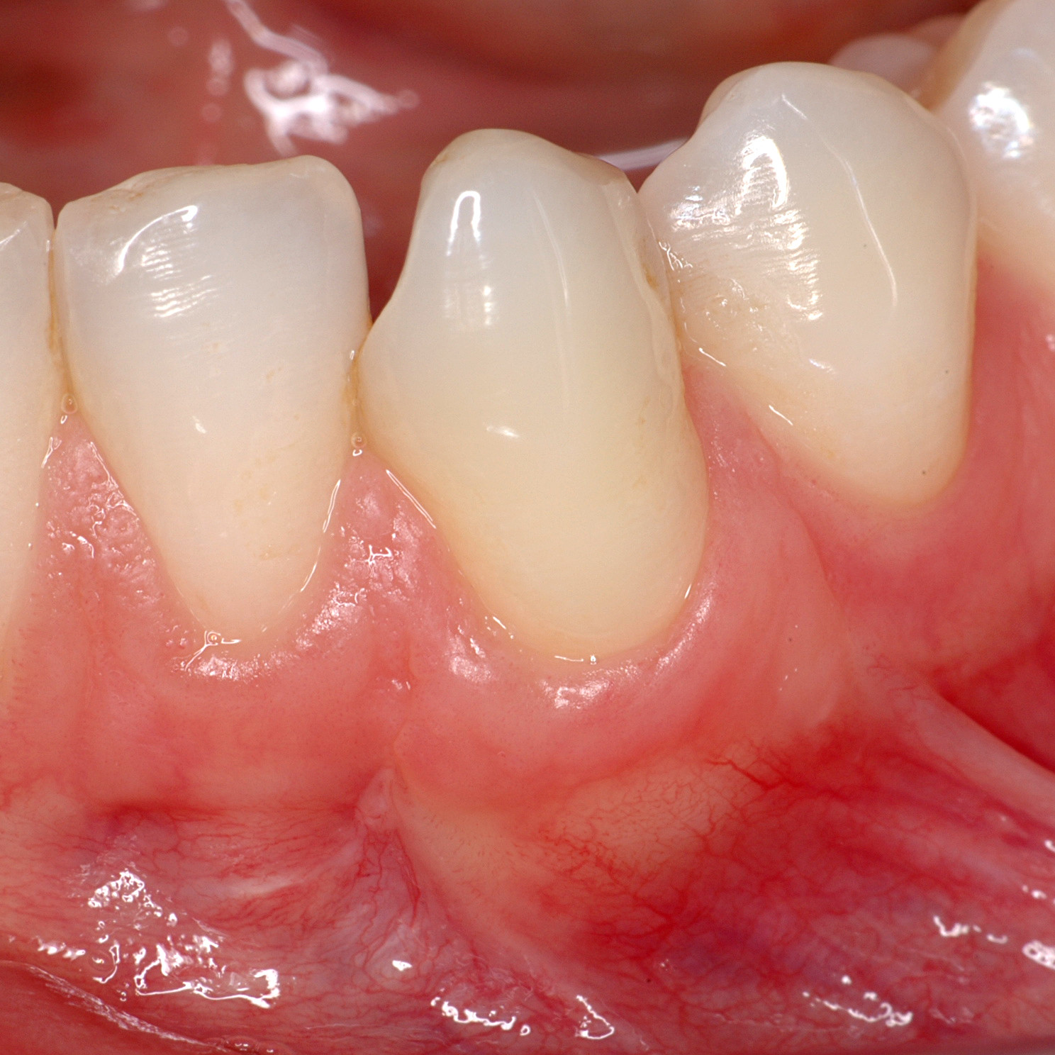Dental Case Weichgewebe, von Prof. Pilloni: Gingivarezession