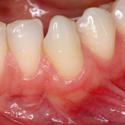 Dental Case soft tissue, by Prof. Pilloni: Gingival recession