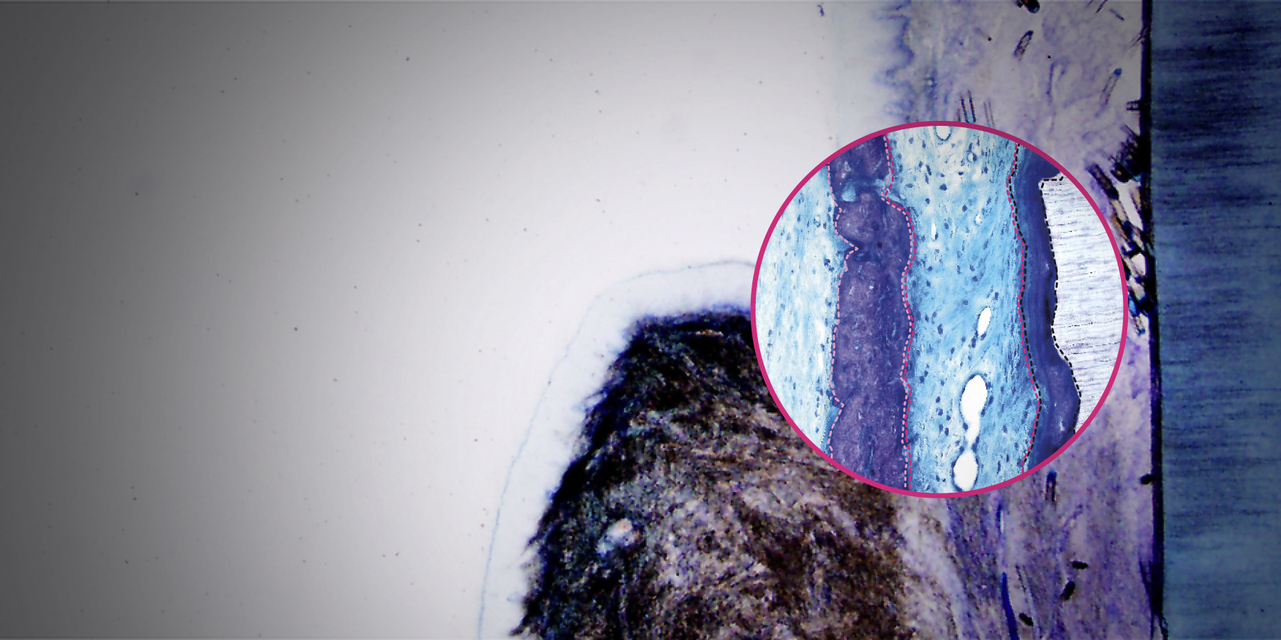 Histologischer wissenschaftlicher Nachweis der Regeneration einer Gingivarezession mit hyadent BG