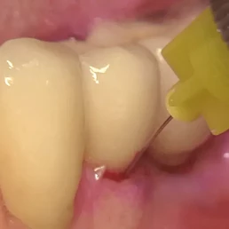 Injection of the xHyA gel into the peri-implant pocket