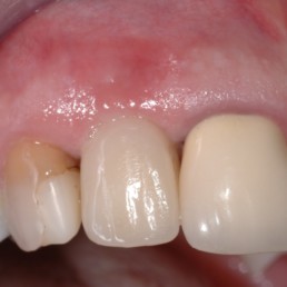 6 months after use of CLEAN&SEAL: Tight tissues, 5 mm pocket depth and with a visible increase in bone around the implant, show that the regeneration of both soft and hard tissues have progressed.