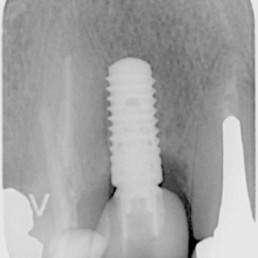 6 mois après l'utilisation de CLEAN&SEAL : des tissus tendus, une profondeur de poche de 5 mm et une augmentation visible de l'os autour de l'implant montrent que la régénération des tissus mous et durs a progressé.