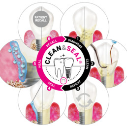 Terapia CLEAN&SEAL per parodontite mucosite periimplantare