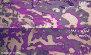 histology DBBM Bio Oss hyadent cross-linked hyaluronic acid HA 2 month Husseini