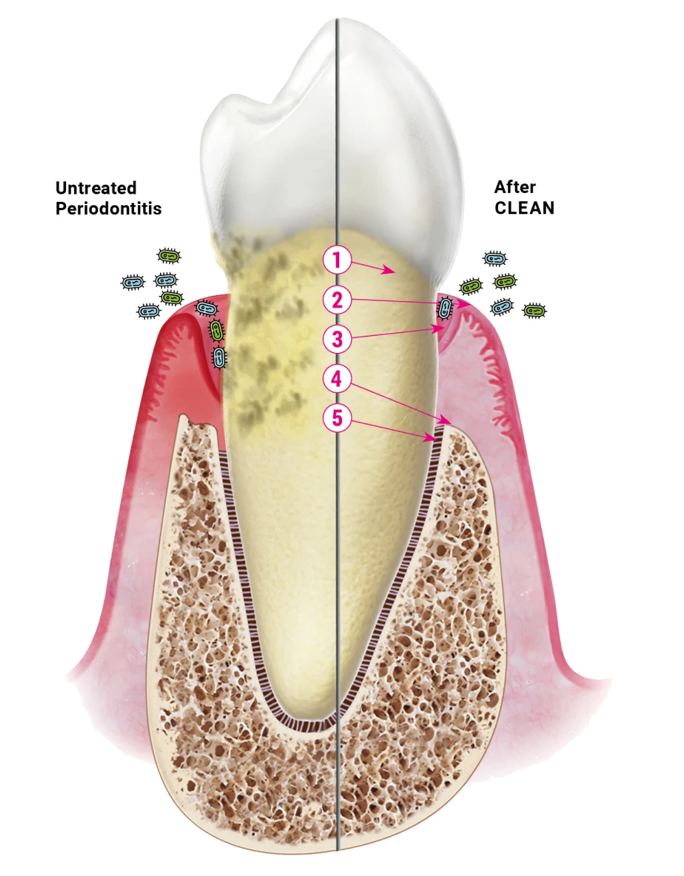 Periodontitis after CLEAN